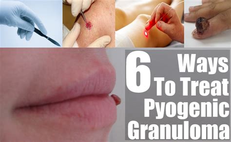 6 Ways To Treat Pyogenic Granuloma – Natural Home Remedies & Supplements