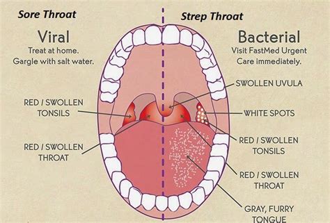 Sore Throat: Causes, Symptoms, & Remedies » How To Relief