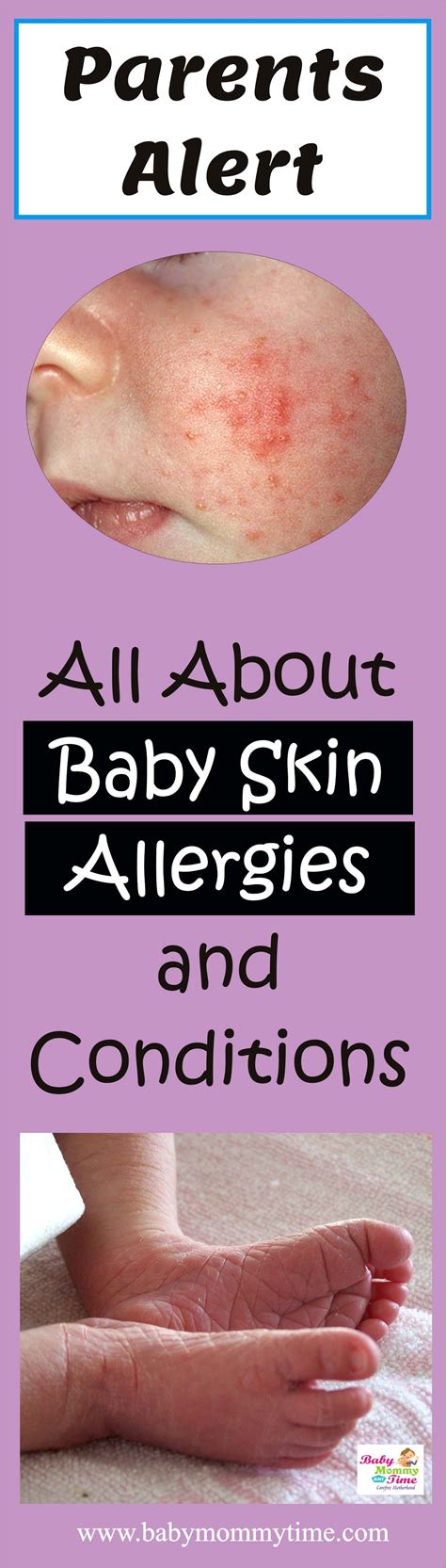 What to Expect from Baby Skin Allergies in 2020 | Skin allergies, Baby ...