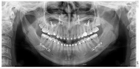 Radiograph after Le Fort I osteotomy with differential reduction and... | Download Scientific ...