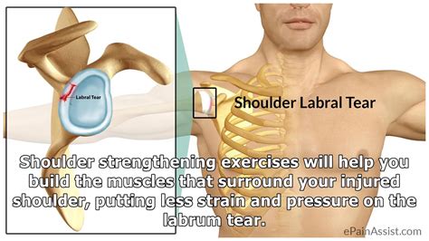 Exercises to Repair and Rehabilitate a Torn Labrum Without Surgery ...