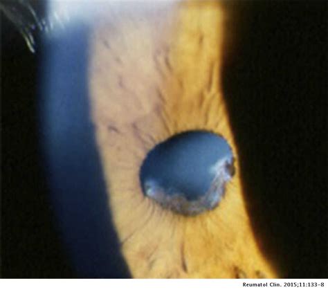 [View 38+] 48+ Posterior Synechiae Of Iris Gif jpg