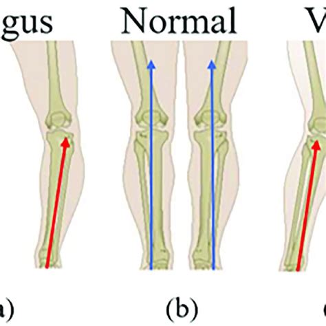 Tibia alignment: Varus (1a), normal (1b), and varus (1c) knee. Red... | Download Scientific Diagram