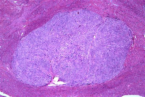 Leiomyosarcoma