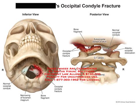 Occipital Condyle Fracture