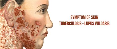 Skin Tuberculosis - Causes, Symptoms, Diagnosis, Treatment & Prevention