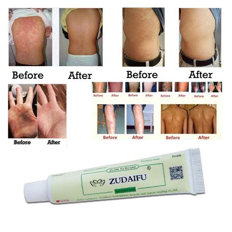 Zudaifu Skin Care Cream Skin Psoriasis Cream Dermatitis Eczematoid ...