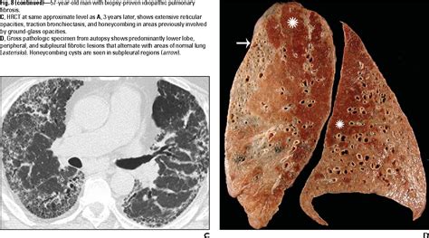 Figure 8 from Idiopathic pulmonary fibrosis: spectrum of high-resolution CT findings. | Semantic ...