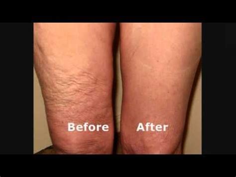 Skinnies Instant Lifts for Thighs - Hide Loose Thigh Skin - YouTube