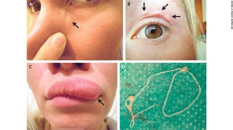 Lump on woman's face turns out to be parasitic worm - CNN