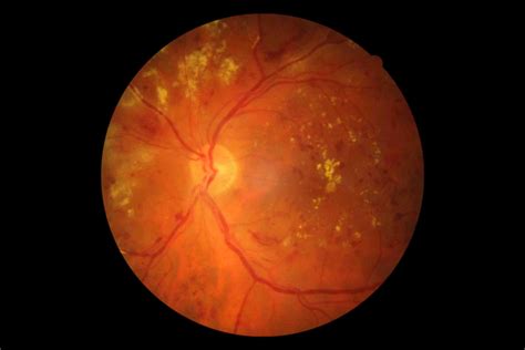 diabetic retinopathy 2 - Eyes Wide Bay