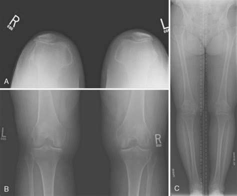 Patellofemoral Arthroplasty | Musculoskeletal Key