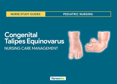 Congenital Talipes Equinovarus (Clubfoot) Nursing Care Management ...