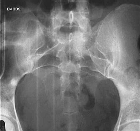 Sacral Fractures - Trauma - Orthobullets