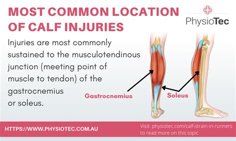 Printable Resource Calf Muscle Strains: What To Expect, 40% OFF