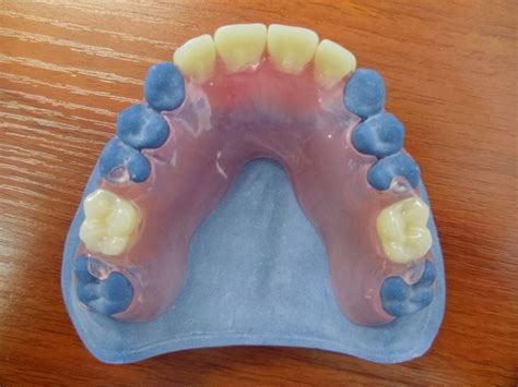 Acrylic Partial Denture | Laboratorio dental, Salud dental, Ortodoncia