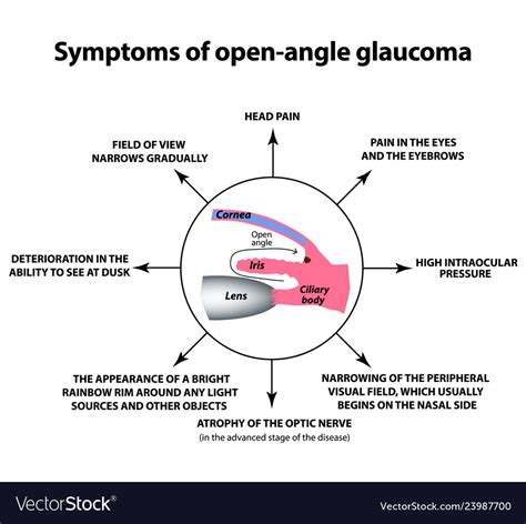 Symptoms of open-angle glaucoma world glaucoma Vector Image