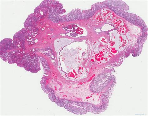 Tubular adenoma of the colon | Atlas of Pathology