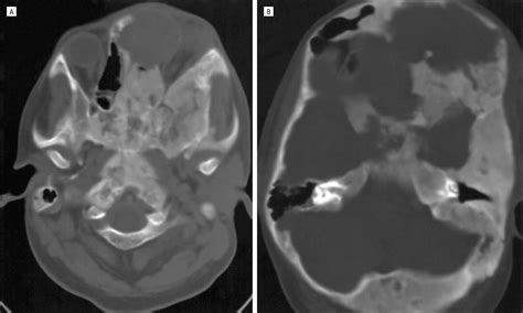 Fibrous Dysplasia Involving the Skull Base and Temporal Bone | Headache ...