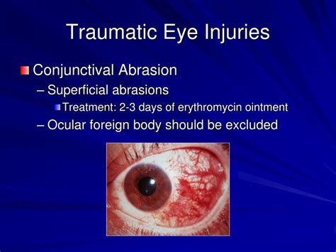 PPT - Eye Emergencies PowerPoint Presentation - ID:355488