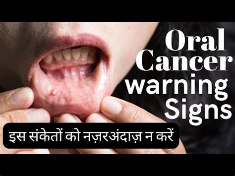 Mouth cancer symptoms in Hindi | early signs of oral cancer - YouTube