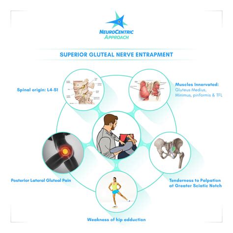 Superior Gluteal Nerve (SGN) - NeuroCentric Approach