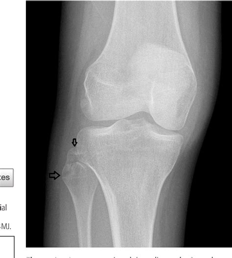 [PDF] Avulsion fracture of the proximal fibula (arcuate sign) in a young woman | Semantic Scholar