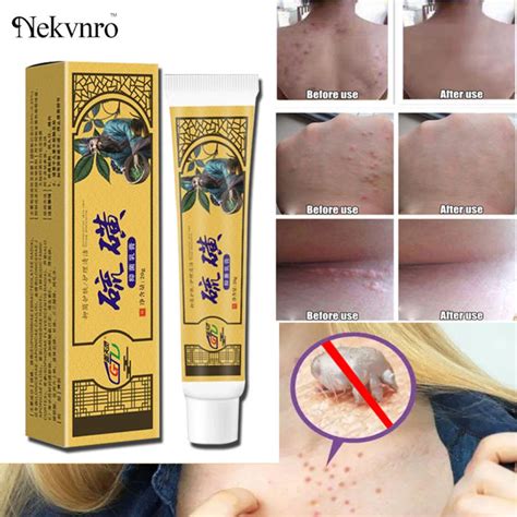 Nekvnro Scabies Ointment Antibacterial Cream Scabies Treatment for ...