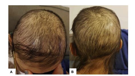 Oral Minoxidil for Permanent Chemotherapy Induced Alopecia — Donovan ...