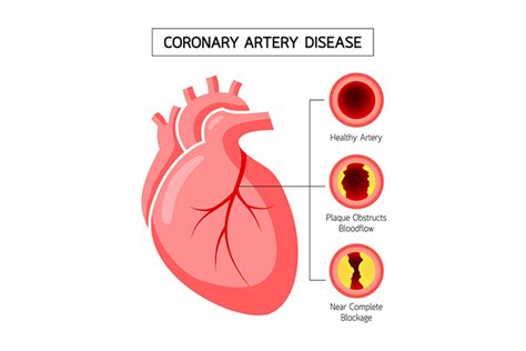 Coronary Artery Disease Symptoms