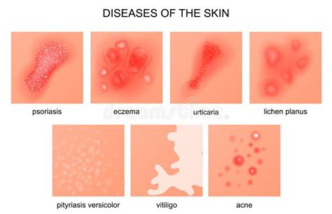 Skin Diseases. Derma Infection, Eczema and Psoriasis Stock Vector ...