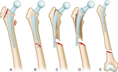 Periprosthetic Fractures around Total Hip Arthroplasty: Evaluation and Management ...