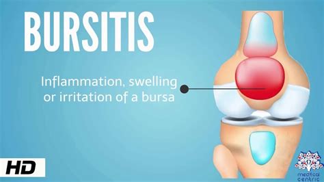 Knee Bursitis | 7 Treatment Tips | Jeremy Burnham, MD