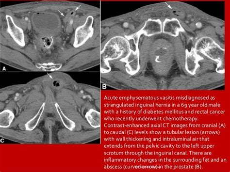 Imaging vastitis differentitis funiculitis seminal vesiculitis Dr Ahm…