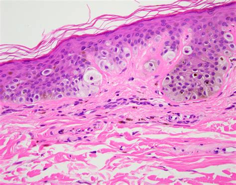 Dysplastic Nevus Histology