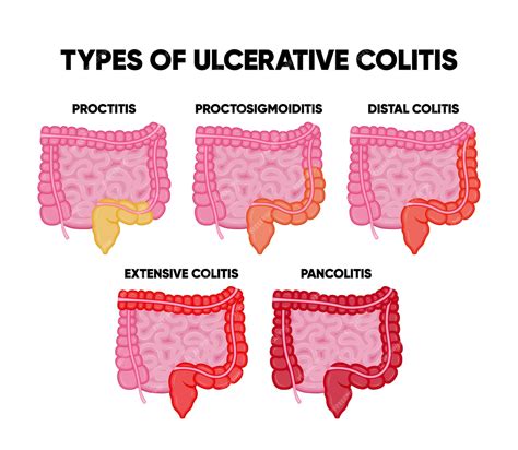 Tipi di colite ulcerosa infografica tra cui proctite colite distale pancolite | Vettore Premium