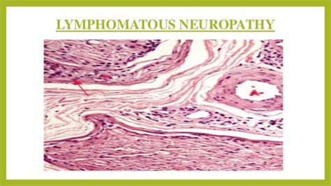 Interpretation of nerve biopsy