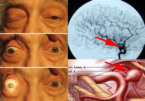 17 Best images about Third Nerve Palsy on Pinterest | Disorders, Branches and Cranial nerves ...