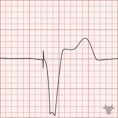 Paced Rhythms | ECG Stampede