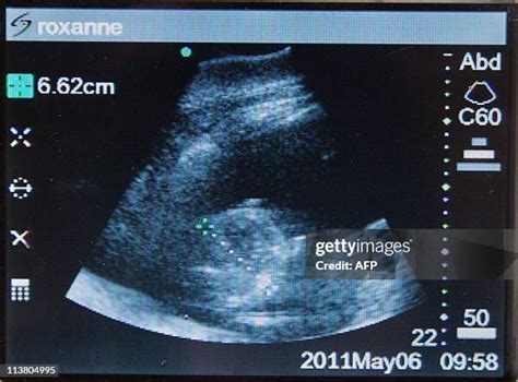 162 Twins Ultrasound Stock Photos, High-Res Pictures, and Images ...