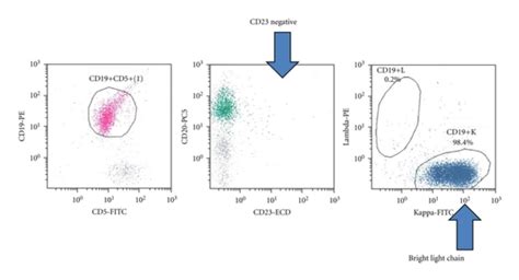 Flow cytometry of mantle cell lymphoma shows CD5 positive B cells which ...