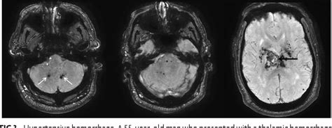 [PDF] Dentate Update: Imaging Features of Entities That Affect the ...