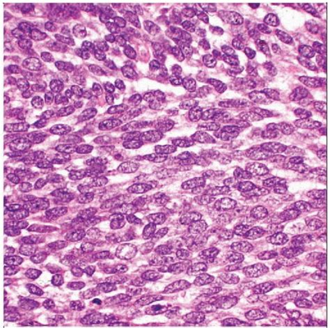 Synovial Sarcoma | Basicmedical Key