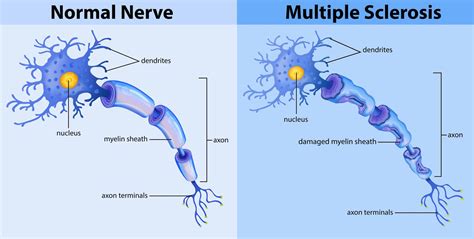 Multiple Sclerosis: Important Things You Need to Know