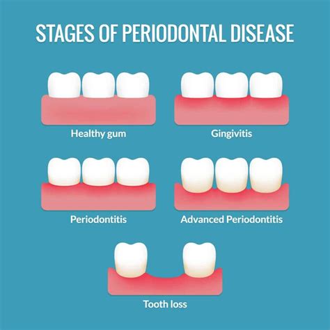 Periodontics - Marina Dentistry