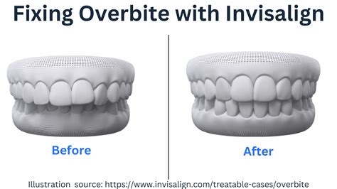 Invisalign Results Overbite