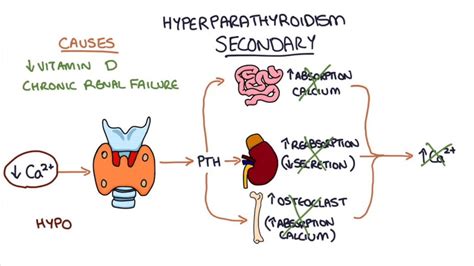 Hyperparathyroidism - Symptoms, Causes & Risk Factors