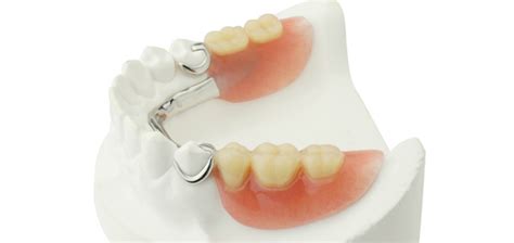 Everything You Need to Know About Partial Dentures