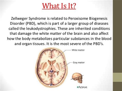 Zellweger syndrome