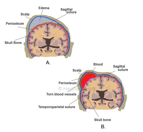 CEPHALOHEMATOMA VS SUBGALEAL HEMATOMA RADIOLOGY - Wroc?awski Informator Internetowy - Wroc?aw ...